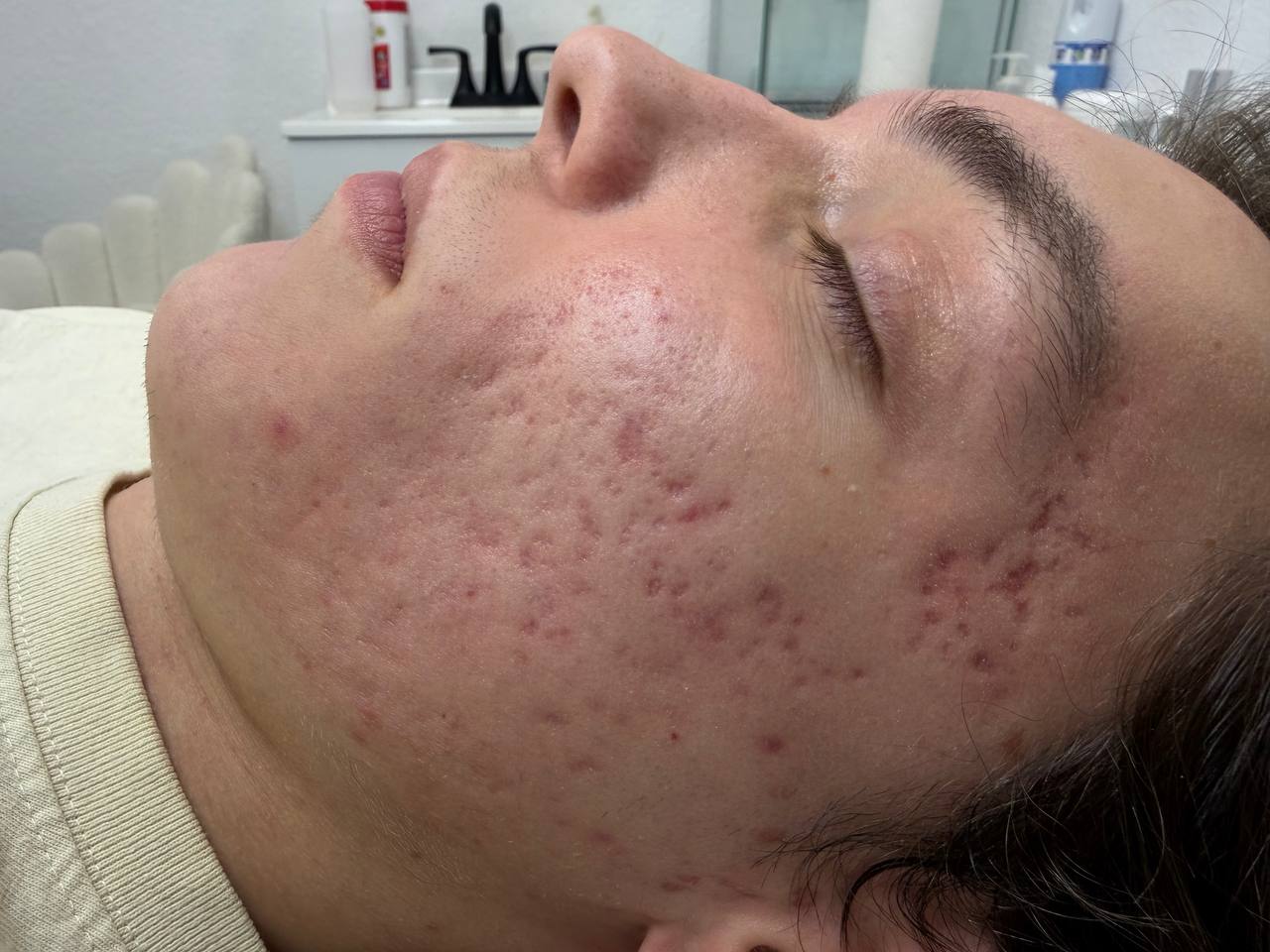 Skin at H.A. Skin Lab, treatment photo