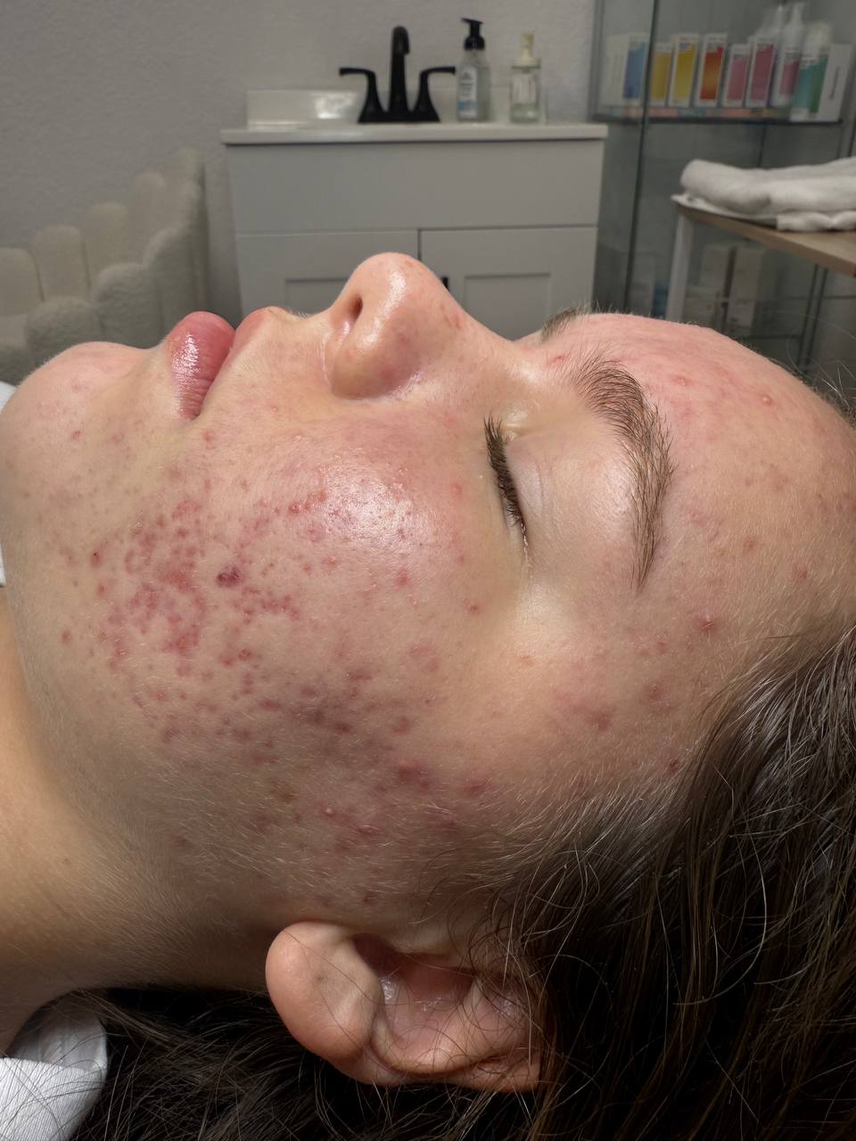 Skin at H.A. Skin Lab, treatment photo