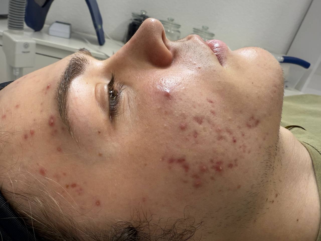 Skin at H.A. Skin Lab, treatment photo