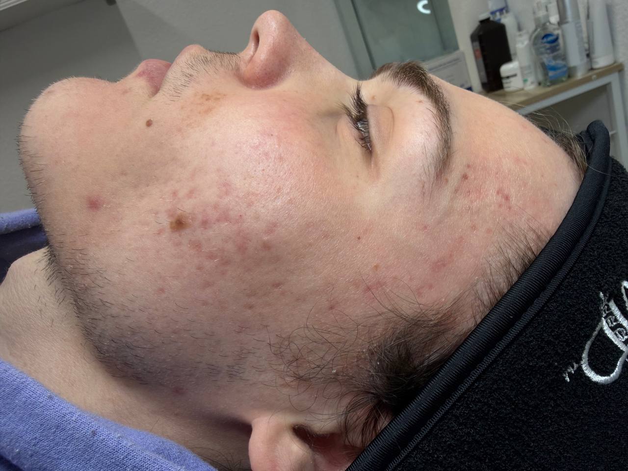 Skin at H.A. Skin Lab, treatment photo