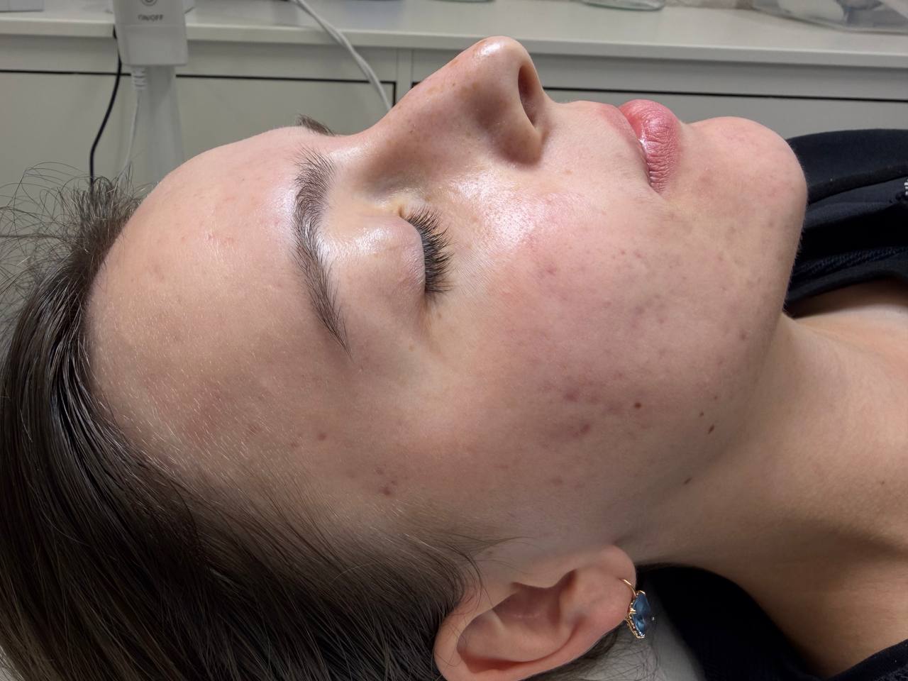 Skin at H.A. Skin Lab, treatment photo